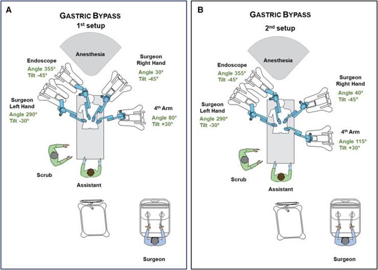 Robotic Gastric Bypass surgical setup diagrams showing arm positioning for 1st and 2nd setup configurations, including Endoscope, Surgeon Right Hand, Surgeon Left Hand, and 4th Arm angles and tilts